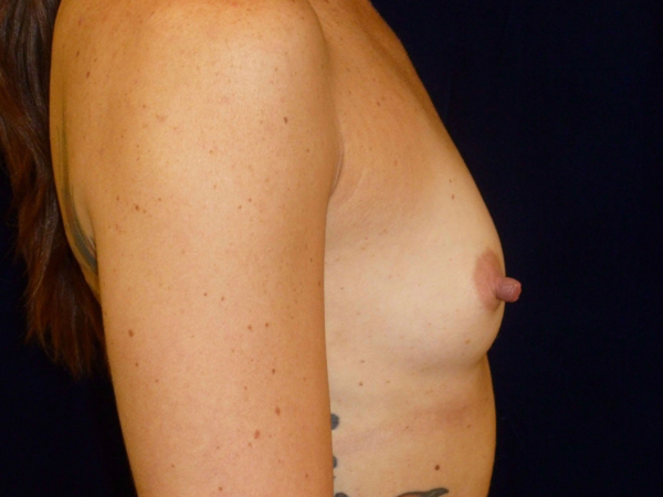 before breast augmentation right side view of female patient 2177