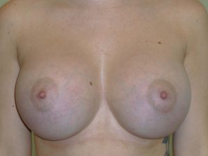 after breast augmentation front view of female patient 2190