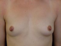 before breast augmentation front view of female patient 2224