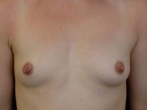 before breast augmentation front view of female patient 2224