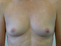 before breast augmentation front view of female patient 2235