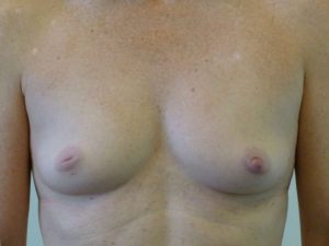 before breast augmentation front view of female patient 2235