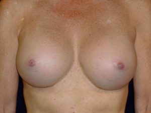 after breast augmentation front view of female patient 2235