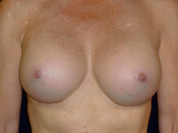 after breast augmentation front view of female patient 2235