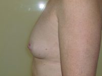 before breast augmentation left side view of female patient 2235