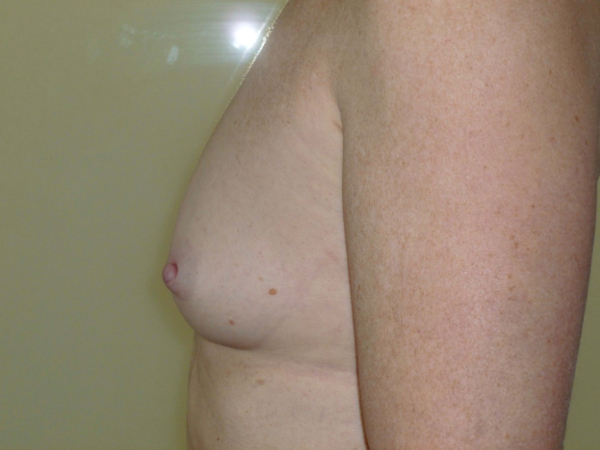 before breast augmentation left side view of female patient 2235