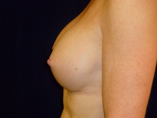 after breast augmentation left side view of female patient 2235