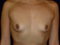 before breast augmentation front view of female patient 2246