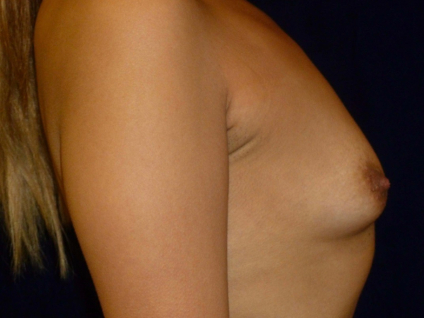 before breast augmentation right side view of female patient 2246
