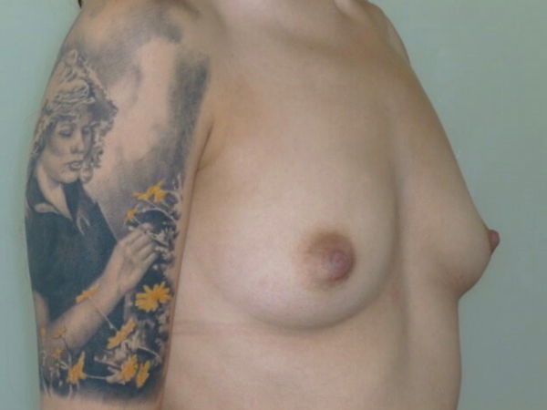before breast augmentation right angle view of female patient 2259