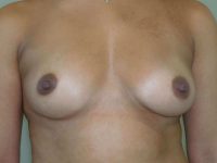 before breast augmentation front view of female patient 2288