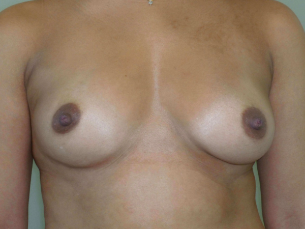 before breast augmentation front view of female patient 2288