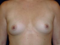 before breast augmentation front view of female patient 2301