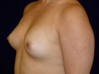before breast augmentation left angle view of female patient 2301