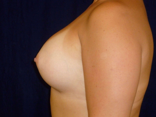 after breast augmentation left side view of female patient 2301